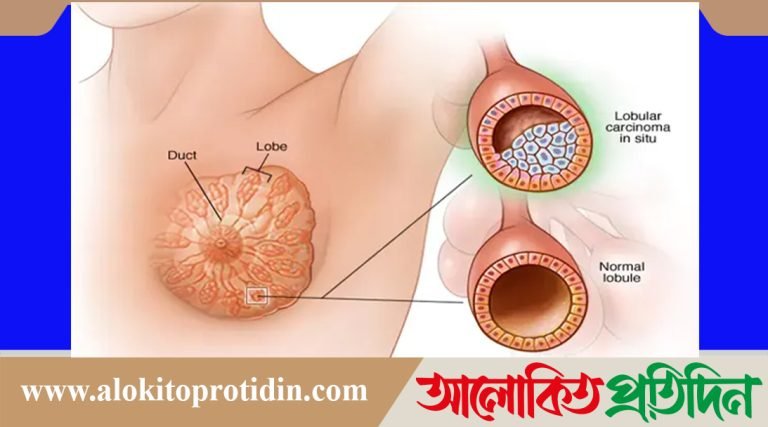 মহিলাদের অল্প বয়সে স্তন ক্যান্সারের ঝুঁকি কেন বাড়ছে!