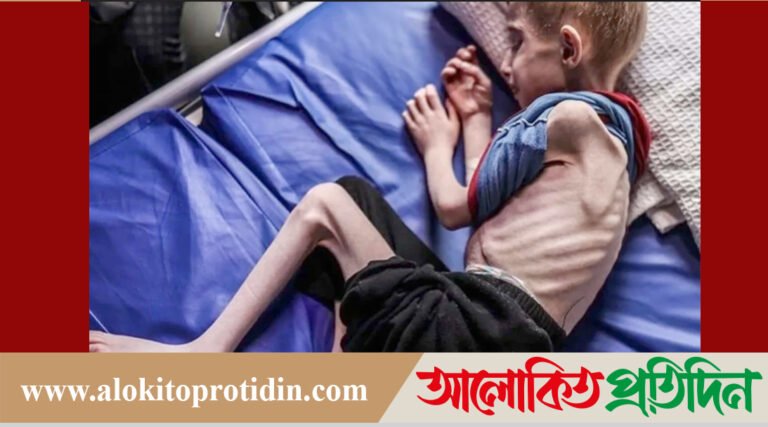 খাদ্যের অভাবে কঙ্কালসার হয়ে গেছে গাজার শিশুরা!
